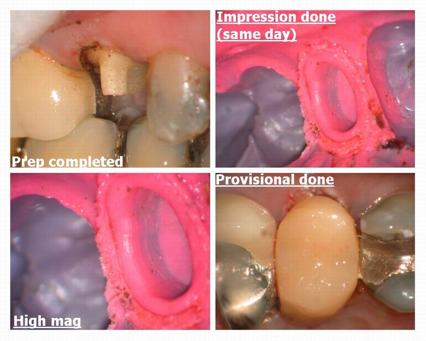 Resize of Premolar recontouring pg 3.jpg